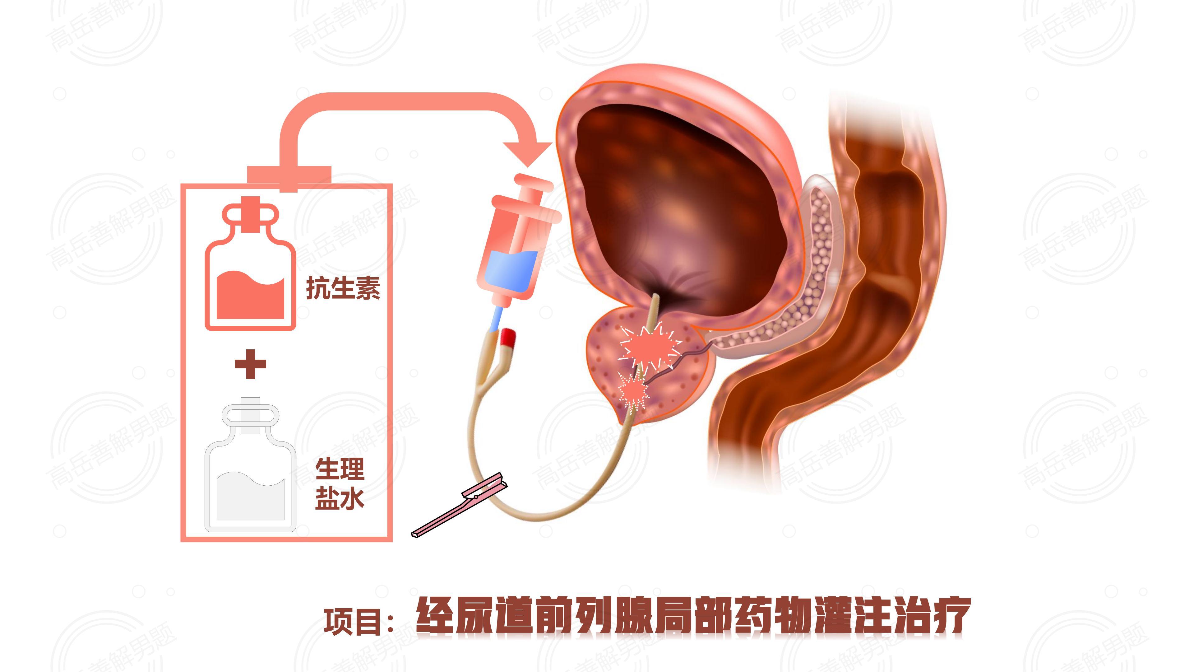前列腺炎最新治疗技术及其步骤指南解析